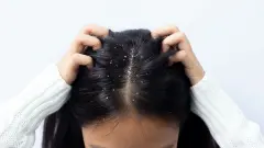 Saçtaki Kepek Sorununa Doğal ve Kesin Çözüm: Uzmanların Önerdiği O Sirke Karışımı! - Portakal Spor